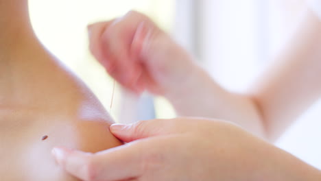 closeup hands of an acupuncturist inserting