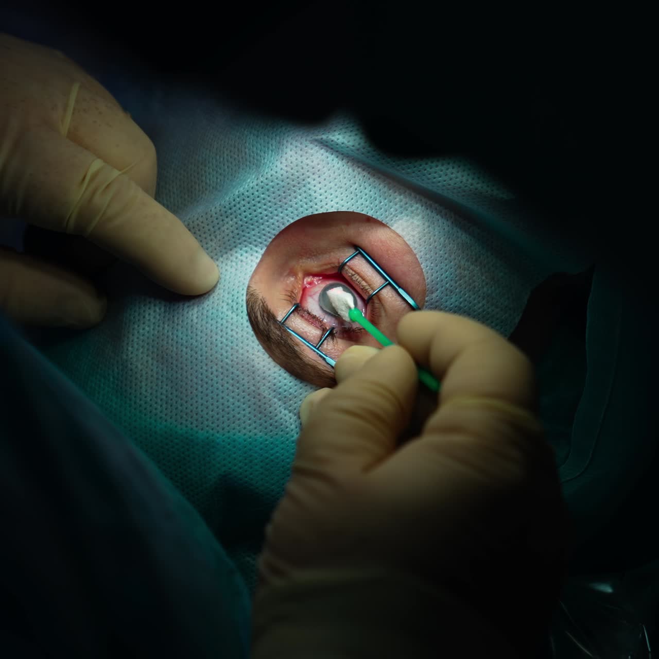 Surgery eye laser correction. Eyesight clinic operating cataract surgery proccess