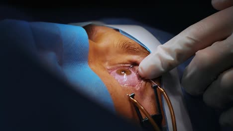 laser vision correction. a patient and team of surgeons in the operating room during ophthalmic surgery. eyelid speculum. lasik treatment. patient under sterile cover