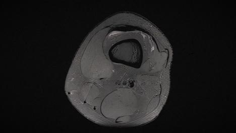 grungy and highly textured vintage mri scan of an injured male knee, after excess basketball playing