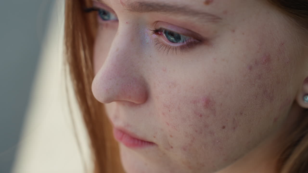 Primo piano di donna bianca con acne, sguardo speranzoso, luce naturale delicata, occhi aperti, texture della pelle visibile, atmosfera da consulto dermatologico, pianificazione del trattamento e routine di cura della pelle, crescente fiducia e calma.