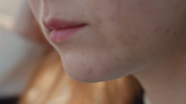 Primo piano bocca e mento di giovane adolescente con acne, attivista determinata che parla dolcemente, luce calda e dorata, sorriso sottile, texture della pelle in via di guarigione, dettaglio lentiggini, inquadratura intima, atmosfera di speranza, attenzione alla voce fuori campo.