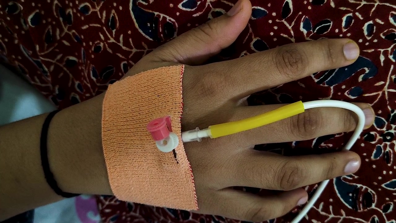 Detaillierte Nahaufnahme einer IV-Kanüle in der Hand eines Patienten während der Krankenhausbehandlung. Ideal für Inhalte zu Gesundheitswesen, medizinischer Behandlung, Genesung, Krankenhausaufenthalt, Versicherung und Wellness.