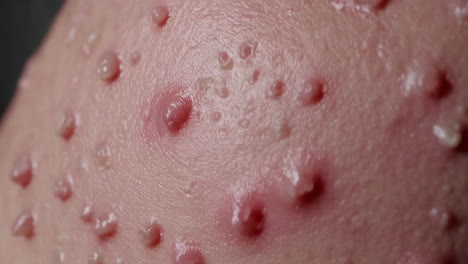 close-up of a severe skin condition with multiple pustules and bumps