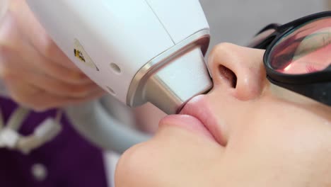 laser hair removal procedure on face