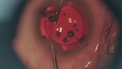 eye lens implantation process. macro footage of eyes during eye surgery. ophthalmological surgery.