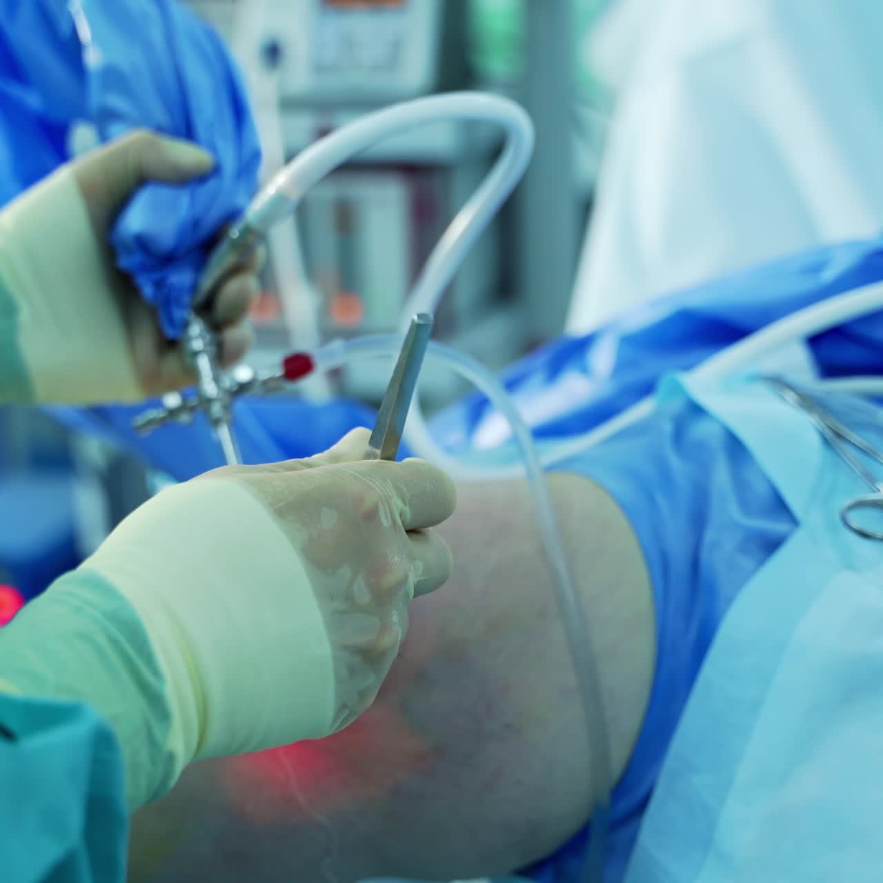Process of trauma surgery operation. Group of surgeons in operating room with surgery equipment