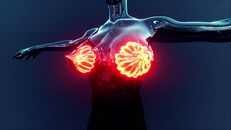 seno femenino con cáncer de foco de inflamación