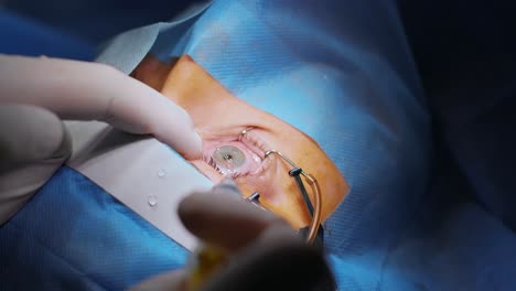 laser vision correction. a patient and team of surgeons in the operating room during ophthalmic surgery. eyelid speculum. lasik treatment. patient under sterile cover