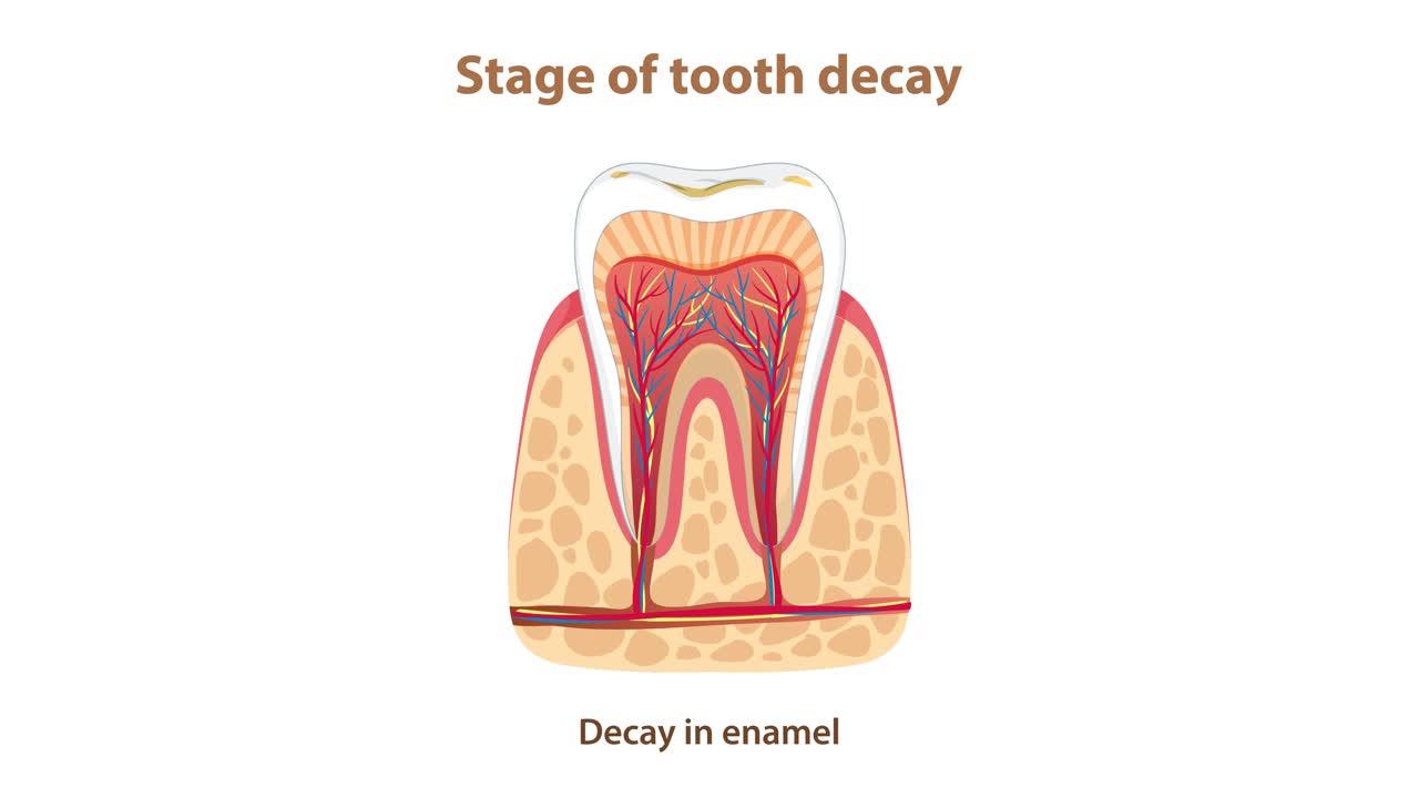 Animated cross-section shows progressive tooth decay stages with labeled enamel, dentin, and pulp diagrams
