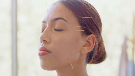 Close-up-of-female-acupuncturist-treating-mixed