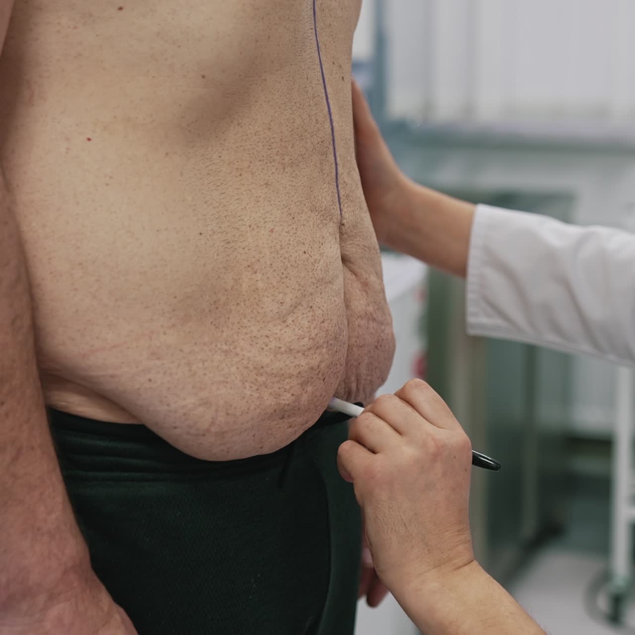 Chirurgo plastico che traccia una linea sull'addome maschile. Medico che prepara l'uomo per un intervento di liposuzione. Procedura prima del bodylifting in clinica