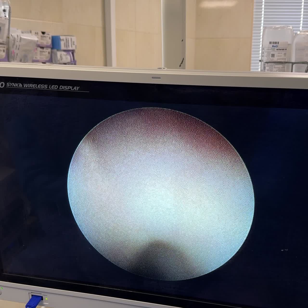 Large monitor in the surgery room showing the endosurgery. Close up. Unrecognized medic covers the patient's hand with a sheet. Vertical screen
