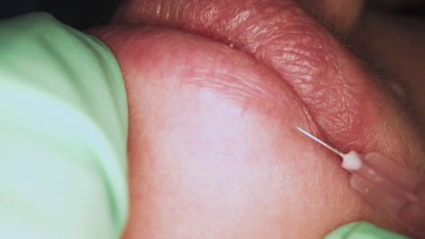 mujer de mediana edad se somete a un doloroso aumento de labios