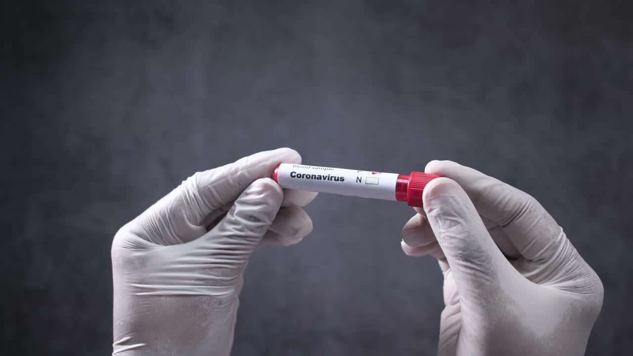 Coronavirus Blood Sample Test