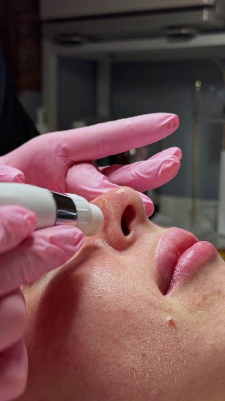 Trattamento professionale per la cura della pelle sul naso di una donna