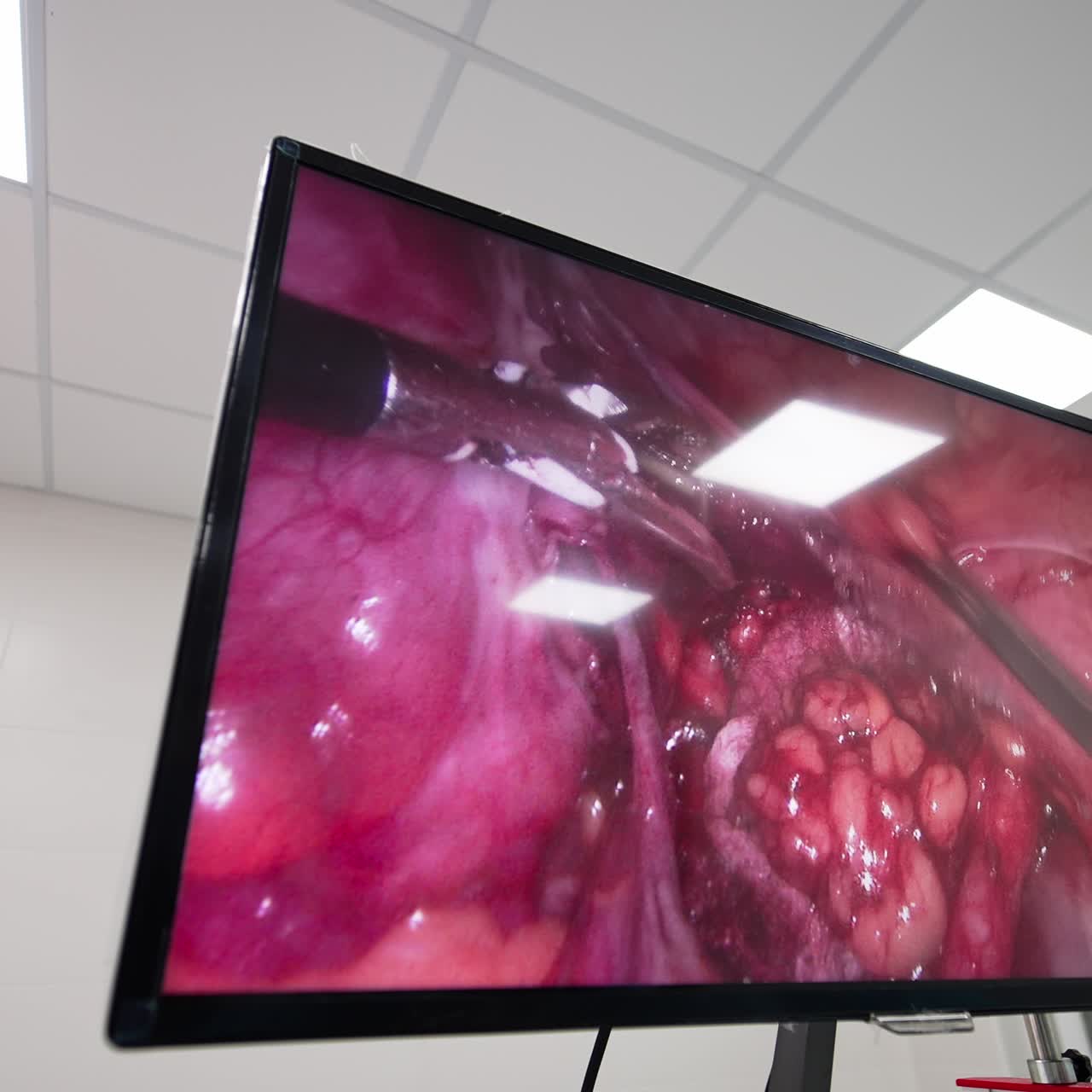 Instrument arms operate the inner organ. Big screen in the surgery room showing the process. Low angle view