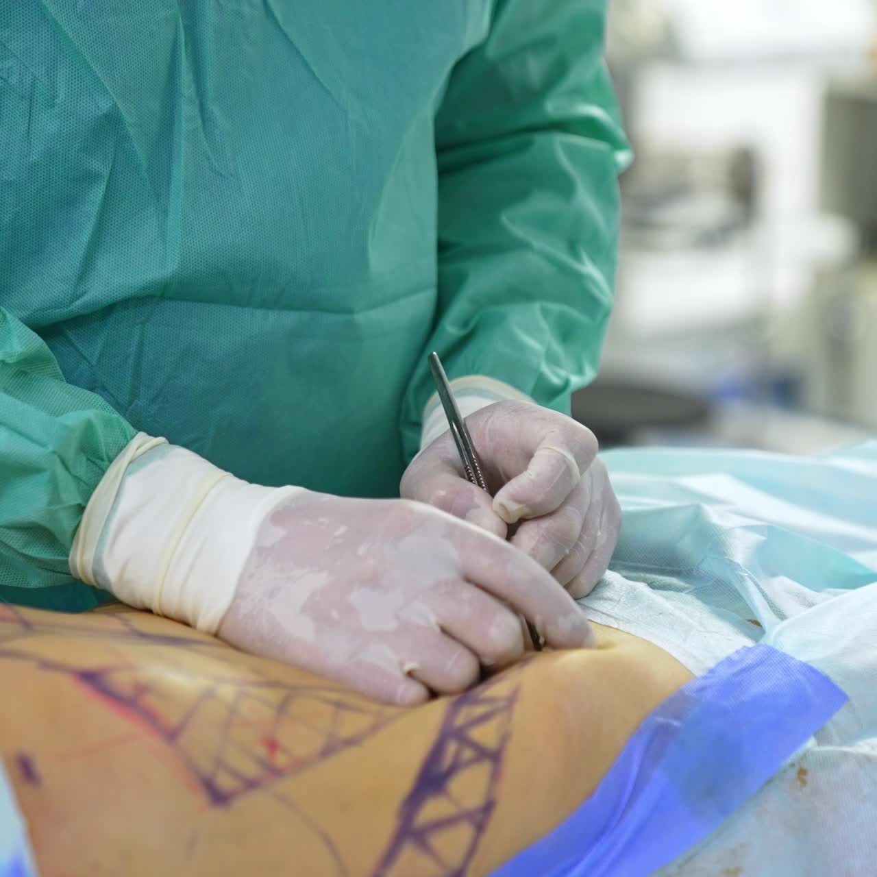 Mani guantate del chirurgo che tiene il bisturi. Lo specialista in chirurgia plastica pratica una piccola incisione nell'addome del paziente. Sfondo sfocato.