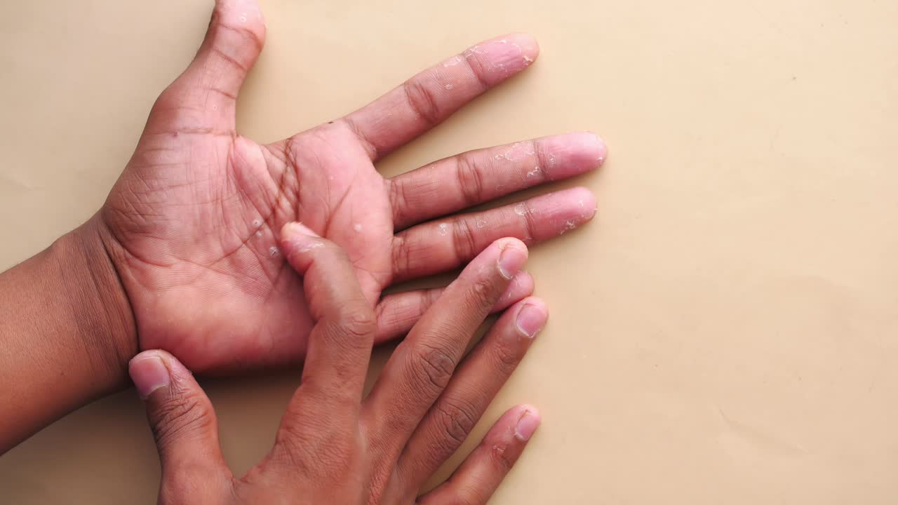 piel seca y escamosa en las manos