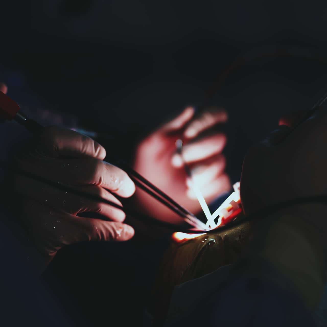 Area operatoria illuminata con le mani di professionisti che maneggiano gli strumenti. Primo piano. Chirurghi che lavorano nell'oscurità della sala operatoria.