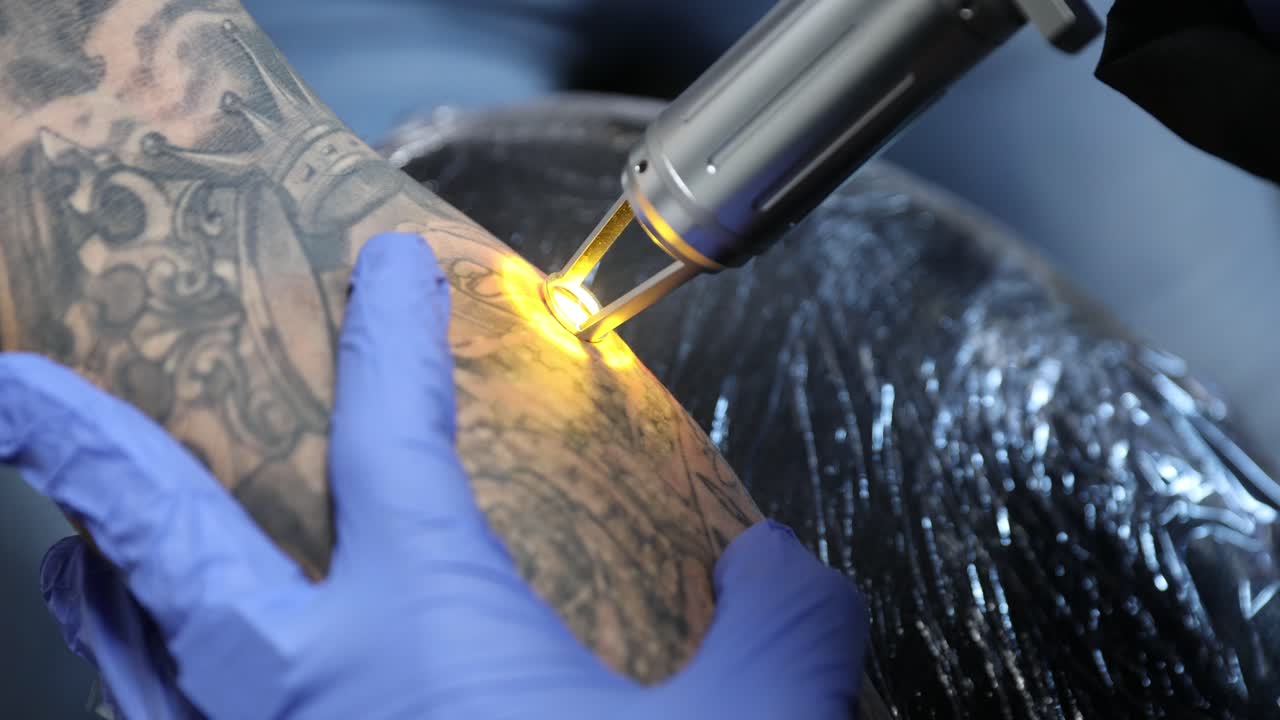 타투 마스터가 클라이언트의 팔에 타투를 제거합니다.