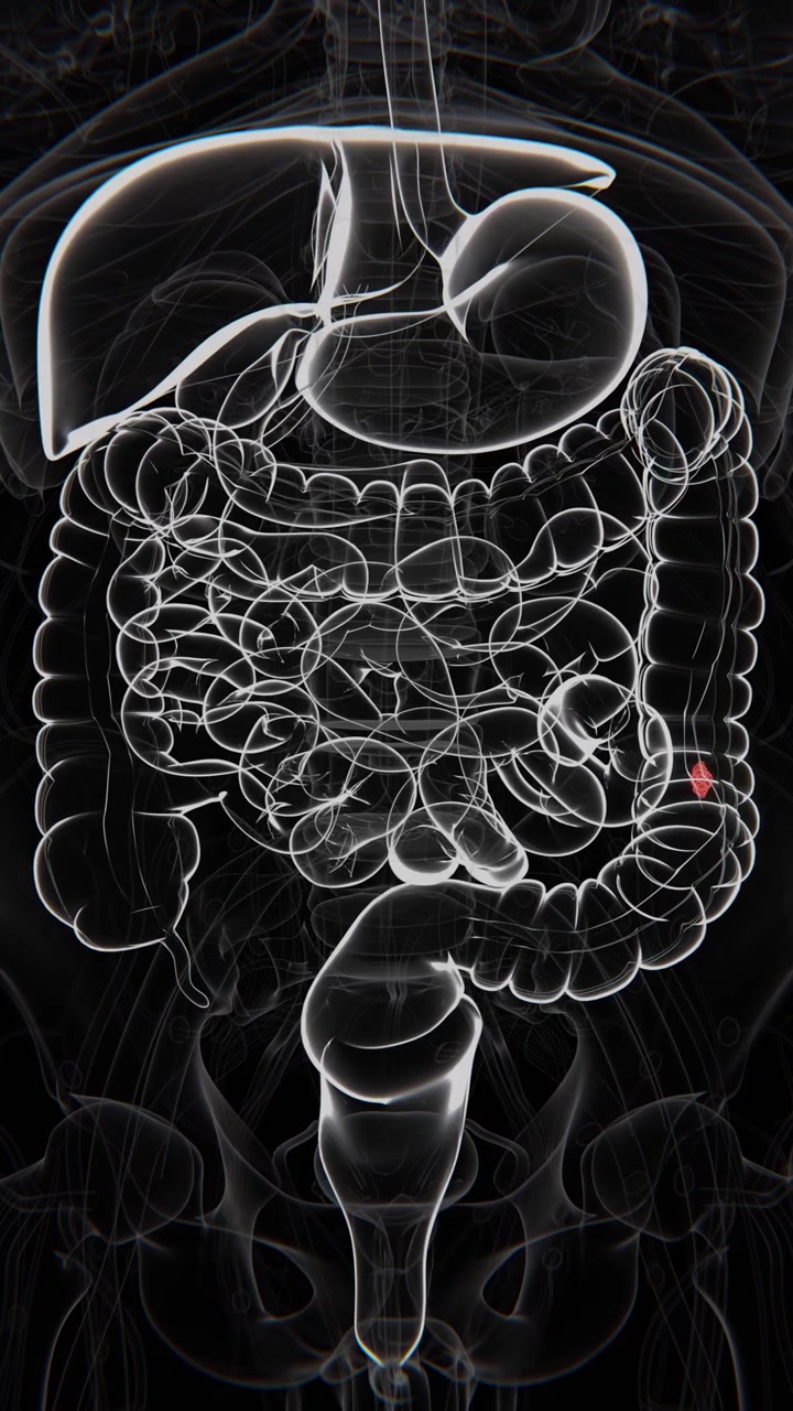 L'angiodisplasia è una raccolta anomala di vasi sanguigni ingrossati e fragili, che si trova più comunemente nel rivestimento del tratto gastrointestinale in video UHD