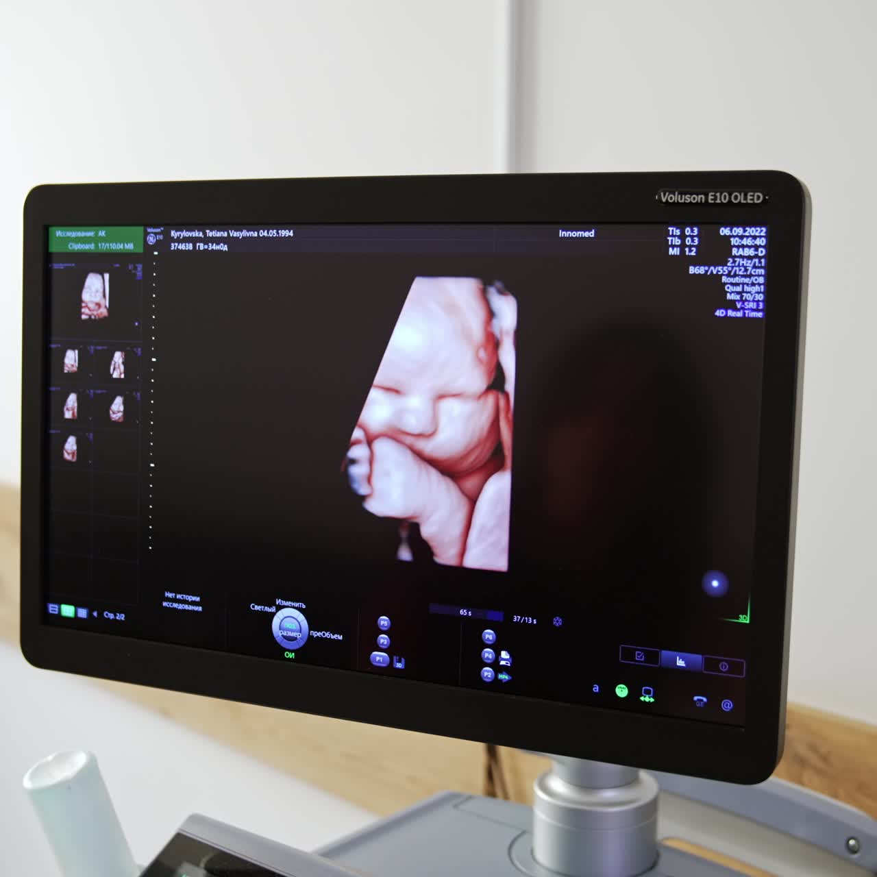 Schermo nero con l'immagine del bambino. Immagine prenatale del nascituro sullo schermo dell'ecografo. Attrezzatura del reparto di maternità