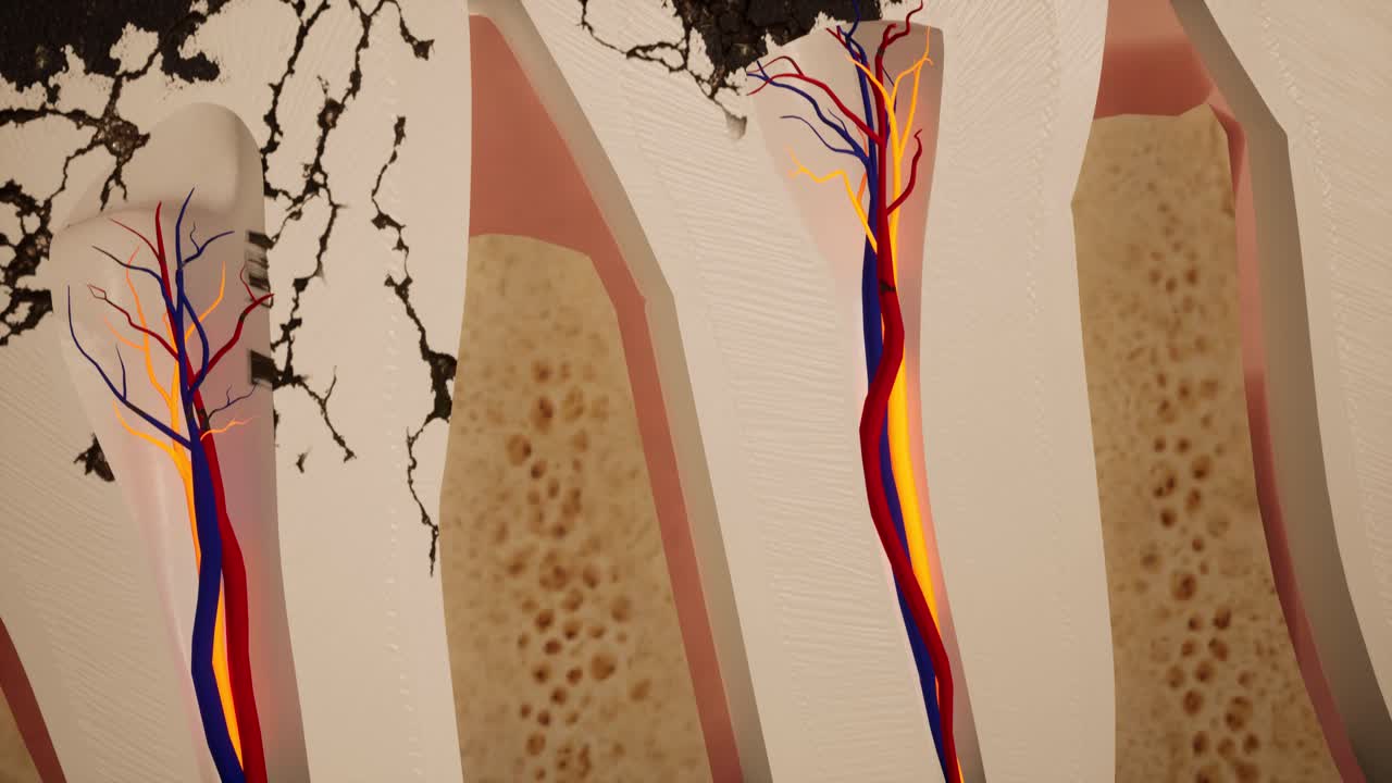 질로 손상된 치아 3d 애니메이션