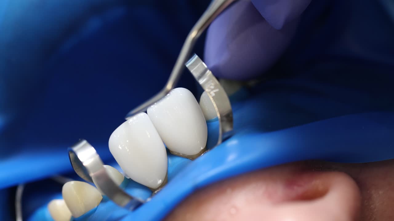 Dentist installs ceramic veneers in patient oral cavity