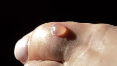close-up of finger female foot blister lesion, natural healing