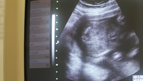 ultrasound image of a fetus