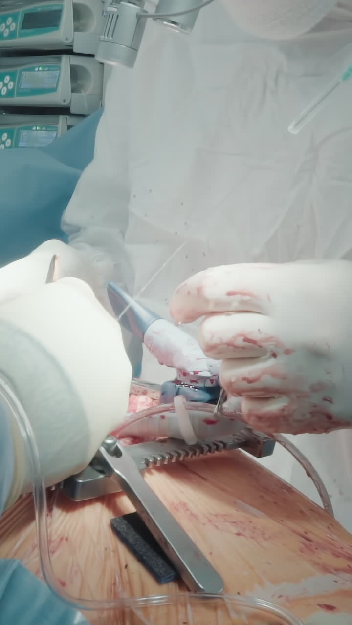 외과 의사는 이식 혈관 수술을 부착합니다. 경험이 풍부한 의사는 수술실에서 조수와 함께 복잡한 관상동맥 바이파스 이식 수술을 수행합니다.