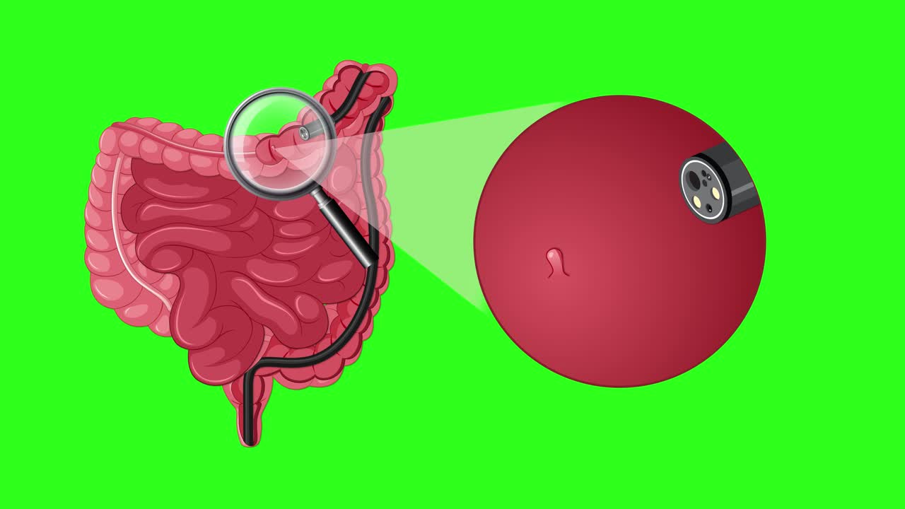 Medical animation illustrating endoscopic polyp removal from colon with green screen background for compositing