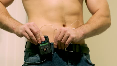 hombre diabético con una bomba de insulina conectada en su abdomen y sosteniendo la bomba de insulina en sus manos. concepto de diabetes.