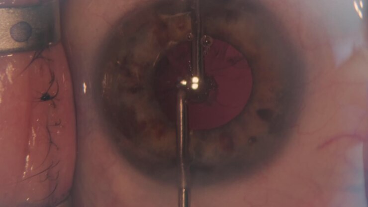 Macro footage of Eyes During Eye Surgery. Ophthalmological surgery.