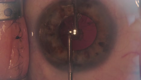 macro footage of eyes during eye surgery. ophthalmological surgery.