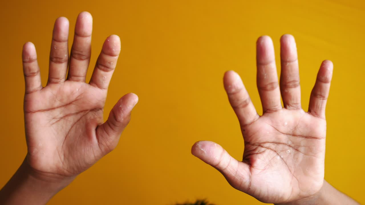 남자의 손의 건조한 균열된 피부 ,