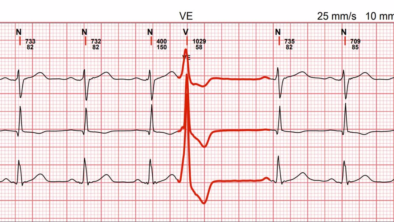 Electrocardiogram, waveform from EKG showing examination test