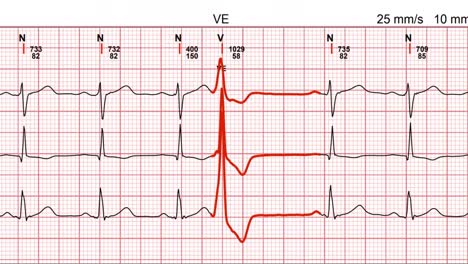 electrocardiogram, waveform from ekg showing examination test