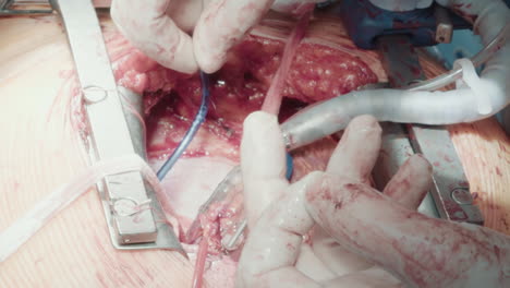 surgeon holds thread operating heart. experienced doctor prepares tool for connecting graft vessels to coronary arteries during complicated surgery