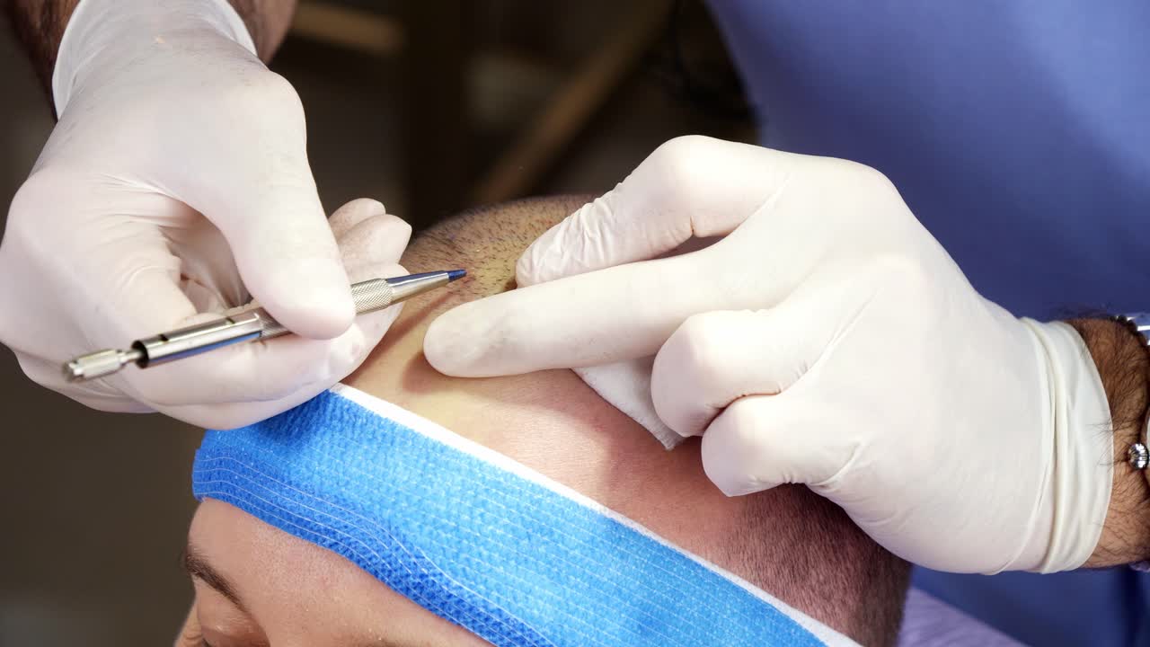 Doctor implanting hair follicles on scalp to treat baldness in live clinical setting