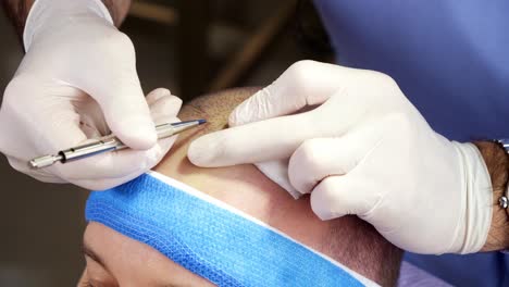 doctor implanting hair follicles on scalp to treat baldness in live clinical setting