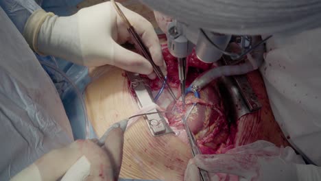 medical staff of the operating unit do heart surgery shunt installation