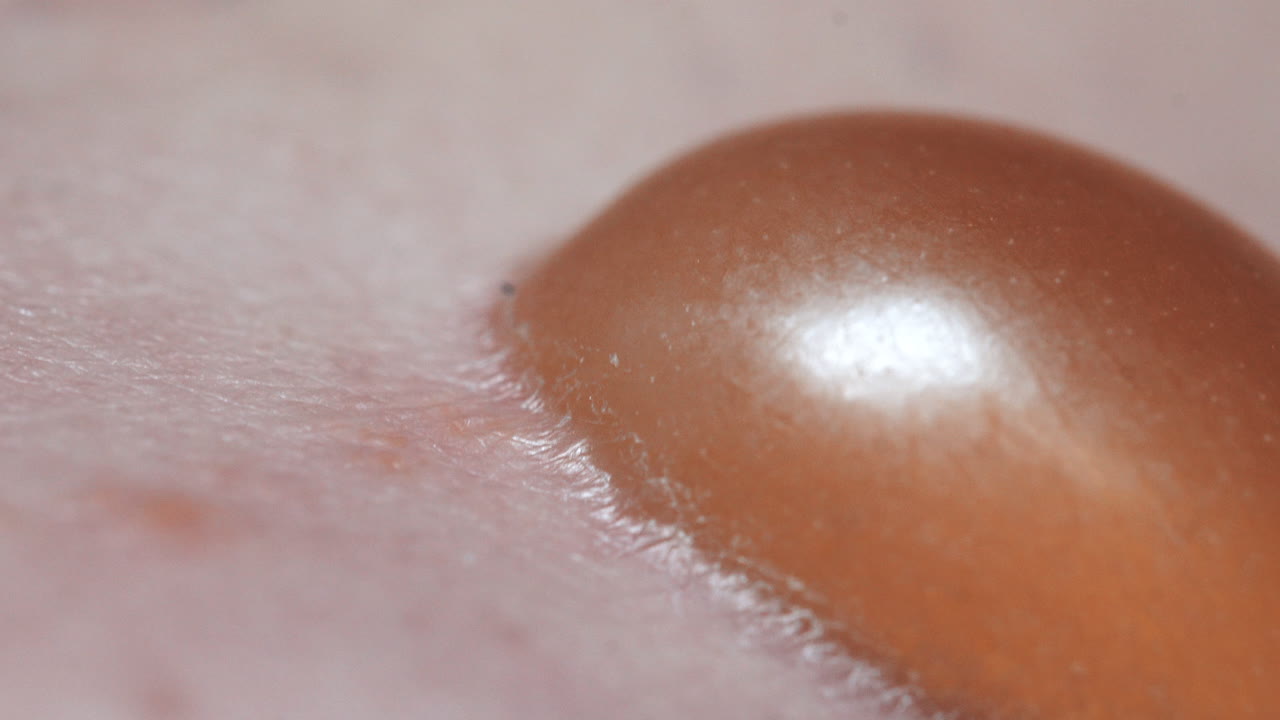 액체로 가득 찬 부어오른 물집, 병원에서 치료받는 고통스러운 피부 감염