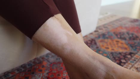 vitiligo on a woman's leg