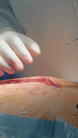 cirujano trabaja con bisturí láser en la clínica de primer plano. cirujano cardíaco abre el camino al corazón del paciente con un cortador moderno en el hospital. cirugía de bypass de la arteria coronaria