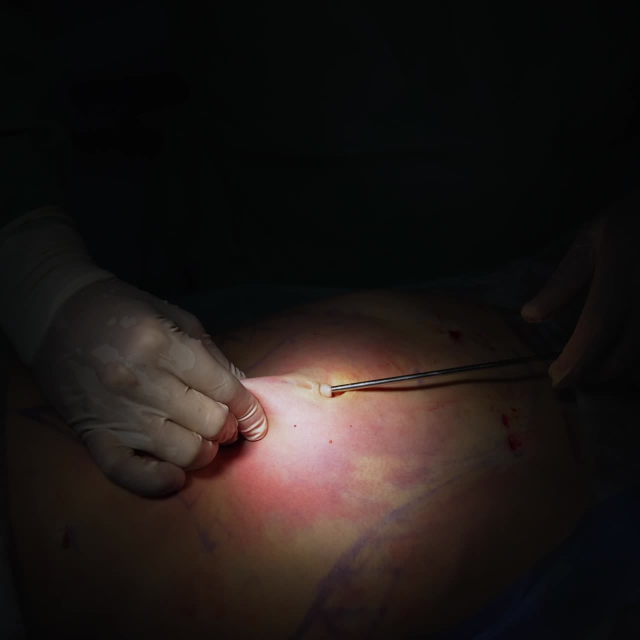 Close up detail of surgery. Close up of surgeon using surgical tool in operating theater