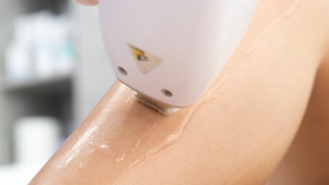 procedimiento de depilación láser en el brazo