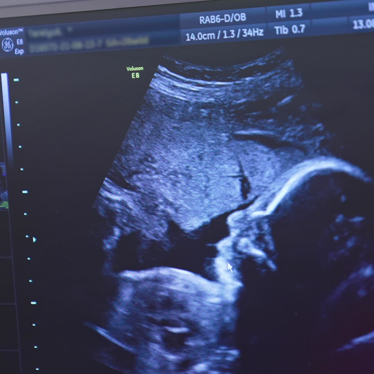 Ecografia di donna incinta. Un piccolo bambino si gira nella pancia della madre. Il bambino nel grembo materno si muove durante l'ecografia.