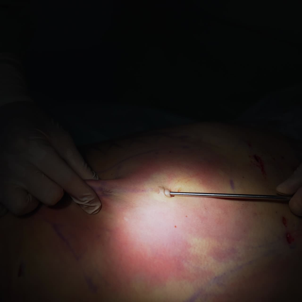 Surgical procedure on patient's belly. Surgical instrument removing fat. Liposuction on black background. Light spot with operation. Close-up